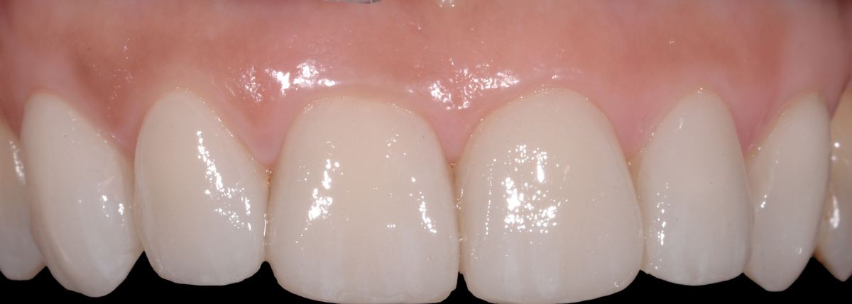Caso di odontoiatria estetica