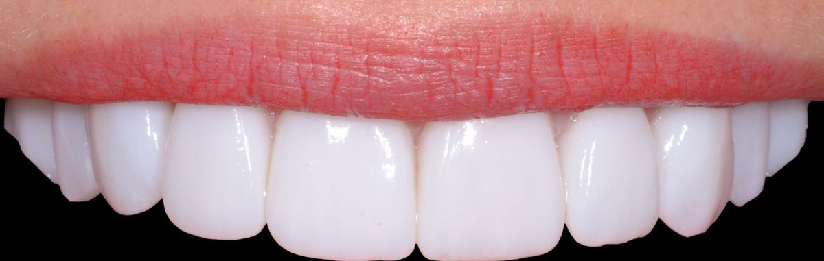 Un sorriso dopo un trattamento di odontoiatria estetica