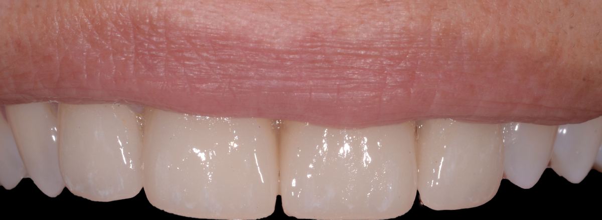 Caso di odontoiatria estetica
