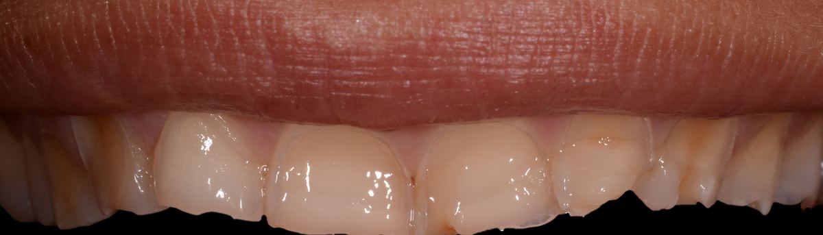 Caso di odontoiatria estetica