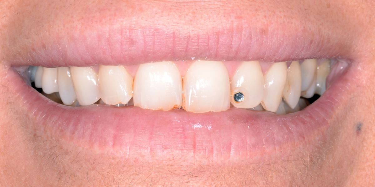 Caso di odontoiatria estetica