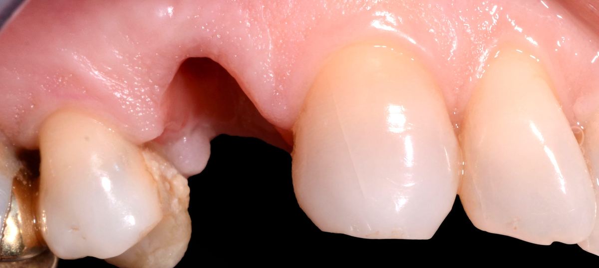 Caso 1 · Impianto per sostituire un dente: sostituzione di un dente fratturato mediante impianto e corona in ceramica zirconia